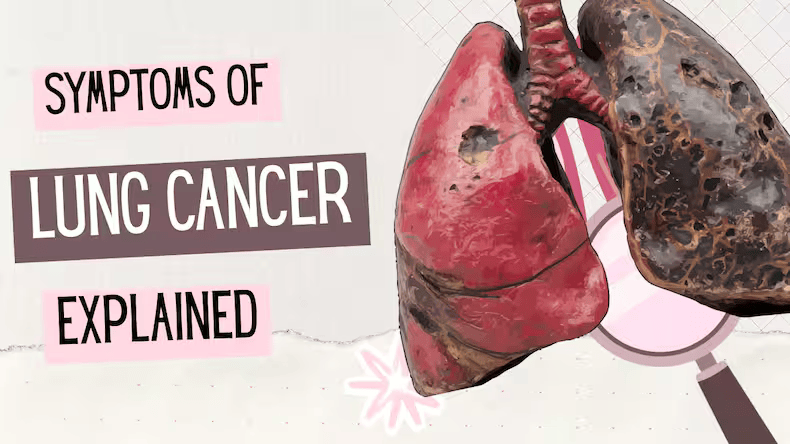 Lung Cancer Alert
